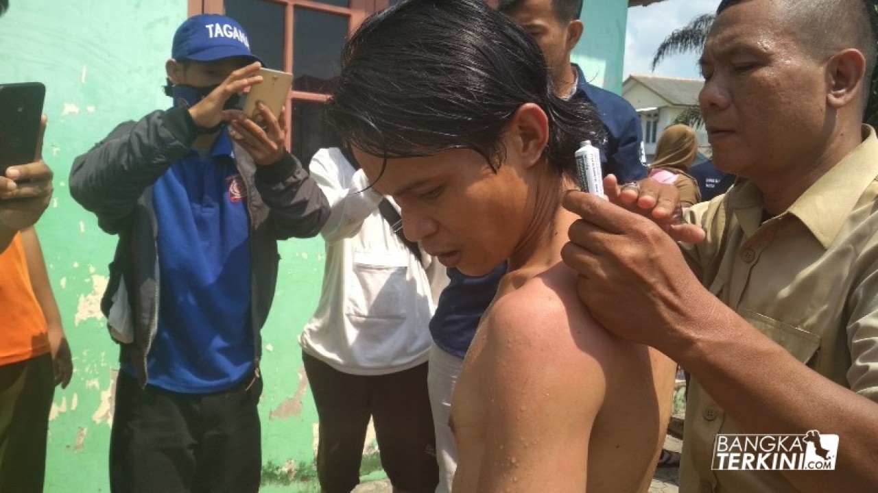 Korban Luka Bakar Ringan (bagian punggung)